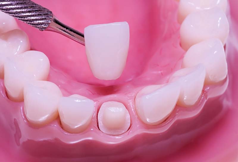 Porcelain Crowns Porcelain Crowns