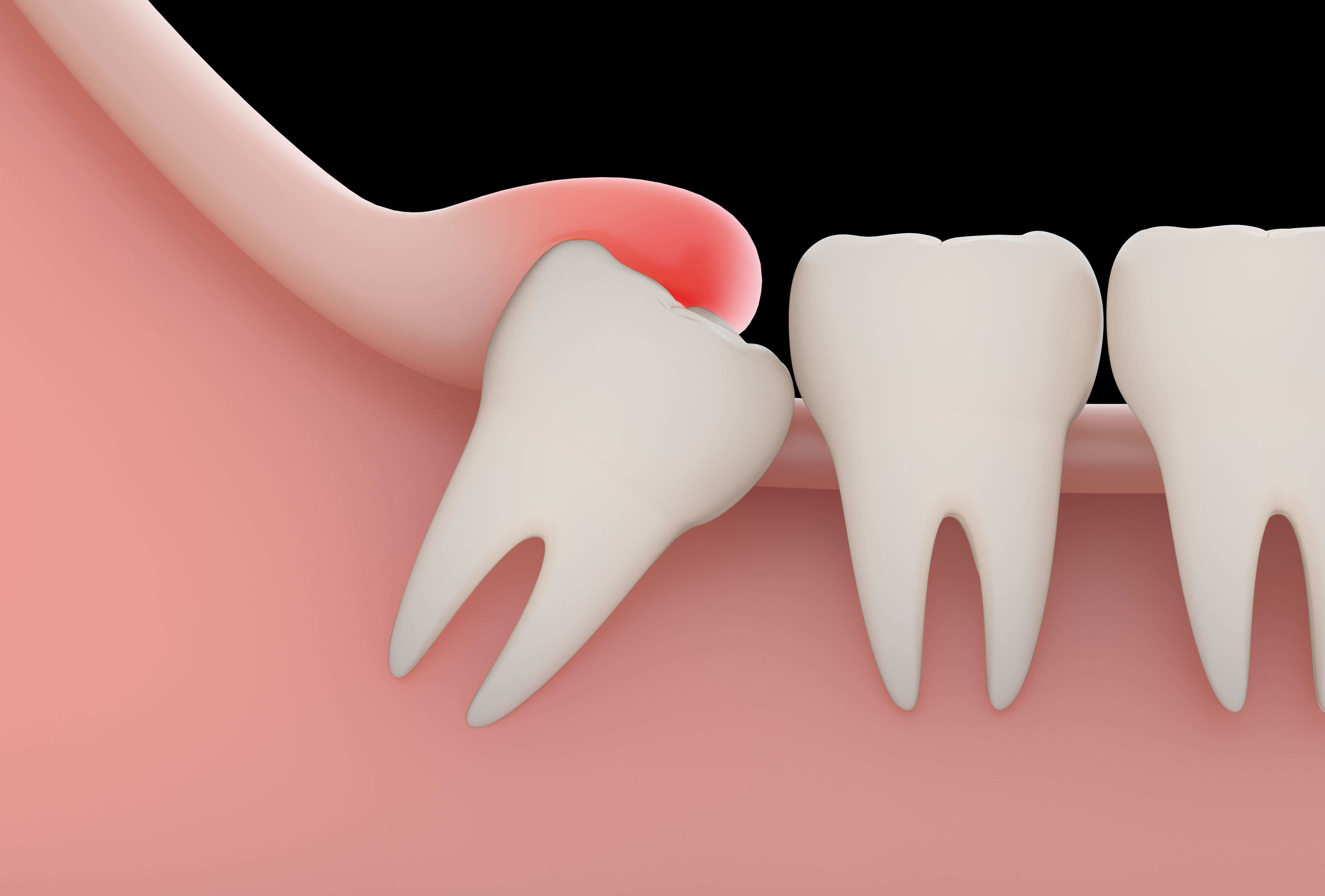 /dental/pages/1532928864-wisdom-teeth-removal.jpg /dental/pages/1532928864-wisdom-teeth-removal.jpg