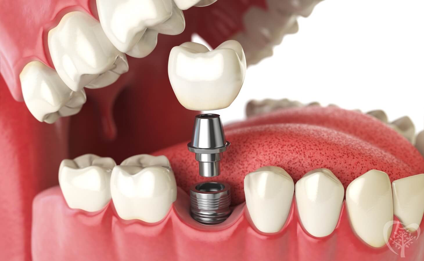 Replacing Missing Teeth Replacing Missing Teeth