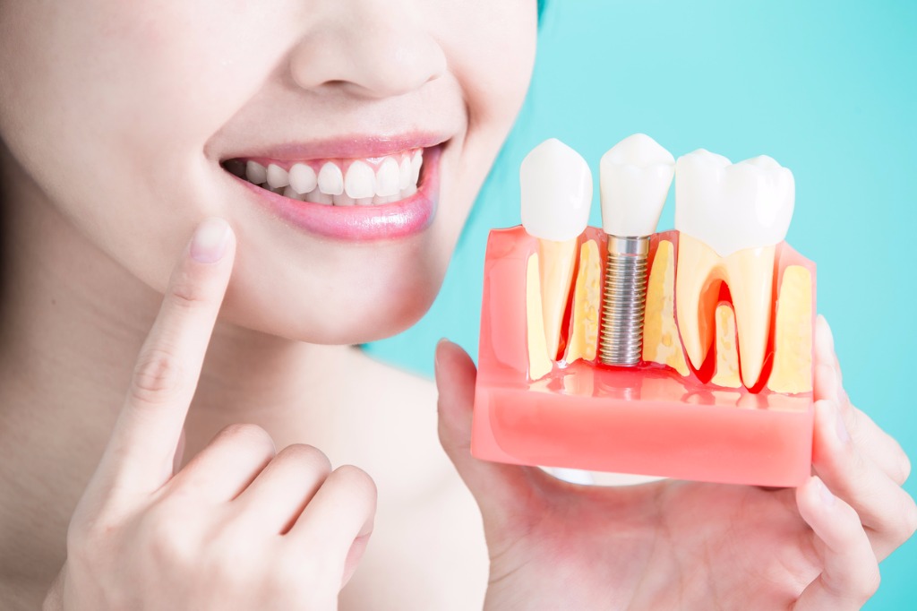 After Implant Placement After Implant Placement