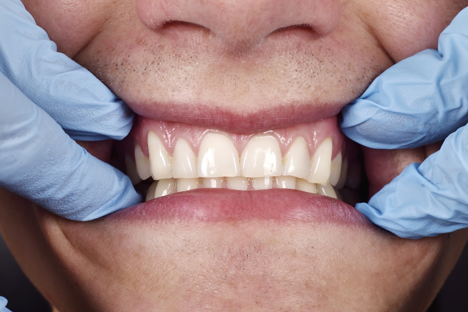 Jaw Bone Health Jaw Bone Health
