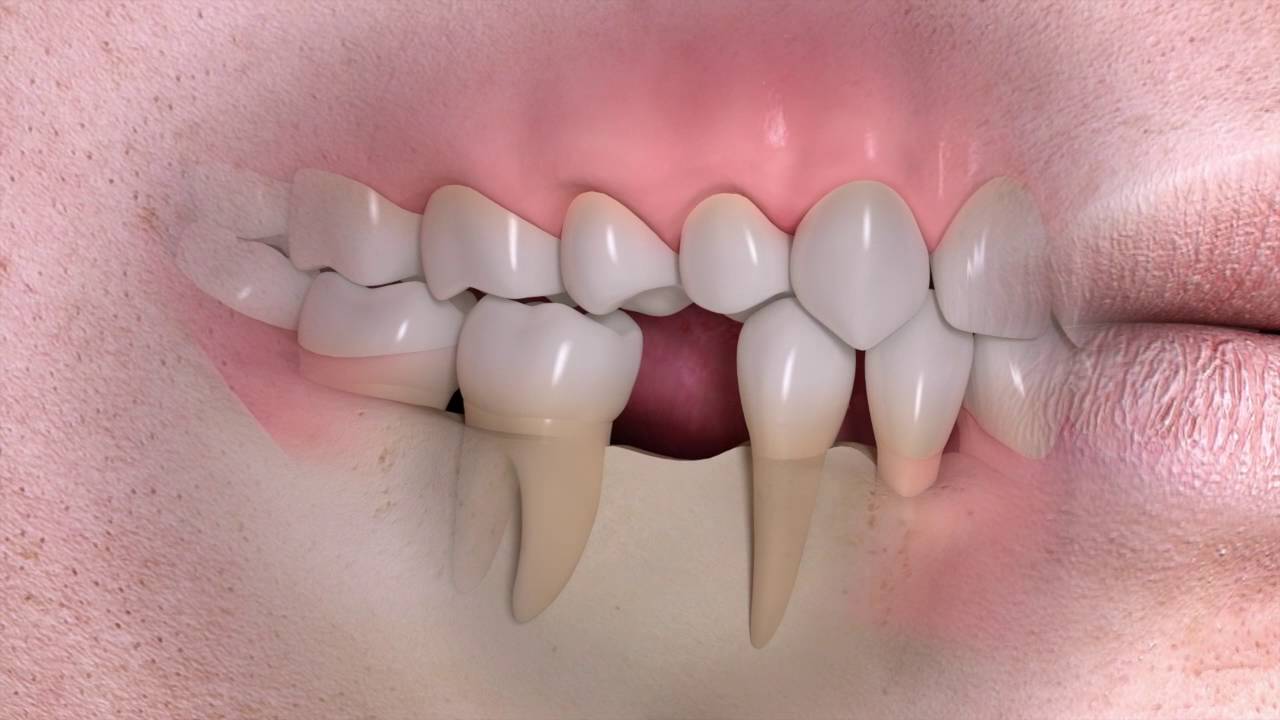 Jaw Bone Loss and Deterioration Jaw Bone Loss and Deterioration