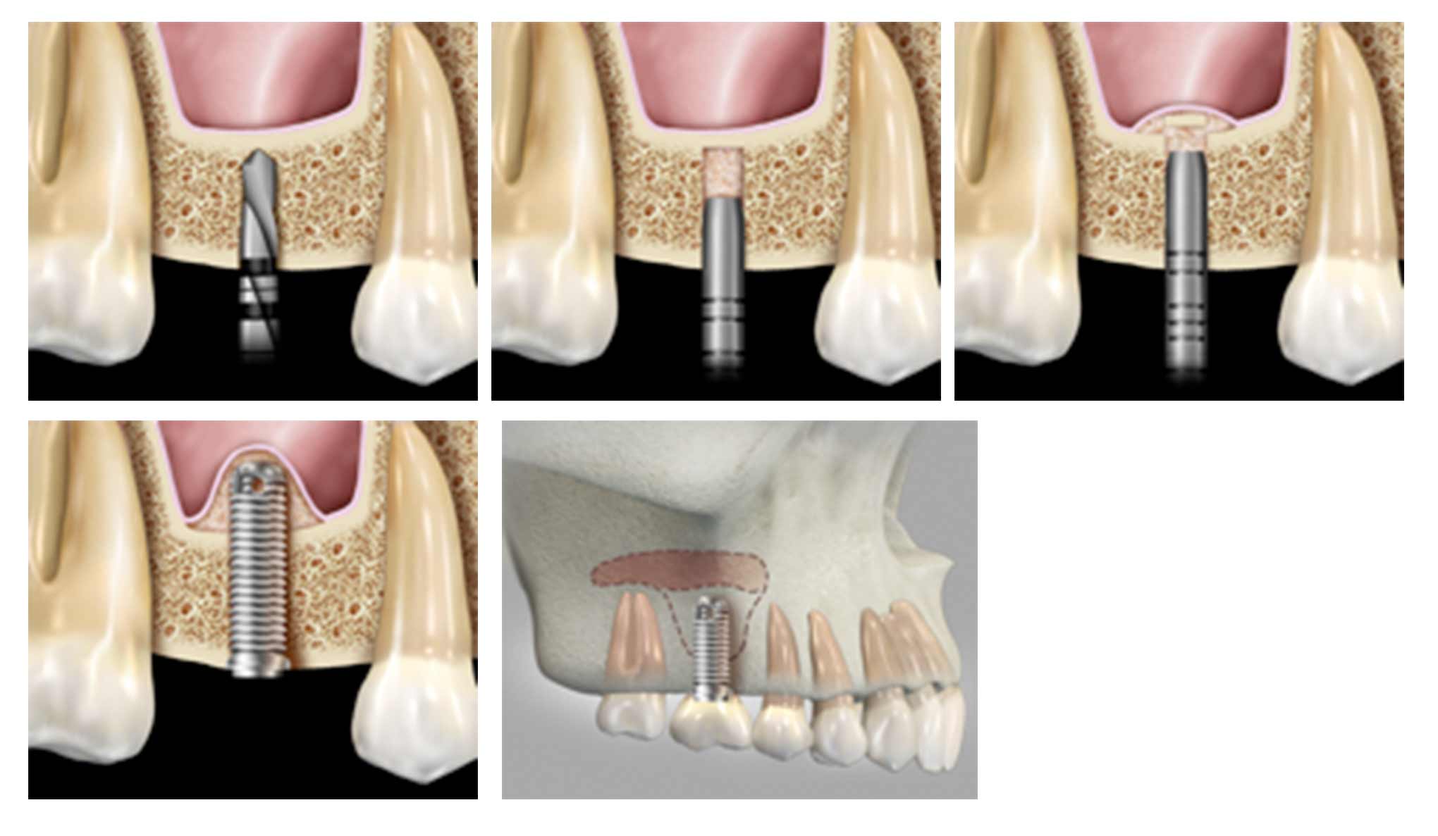Sinus Lift Sinus Lift
